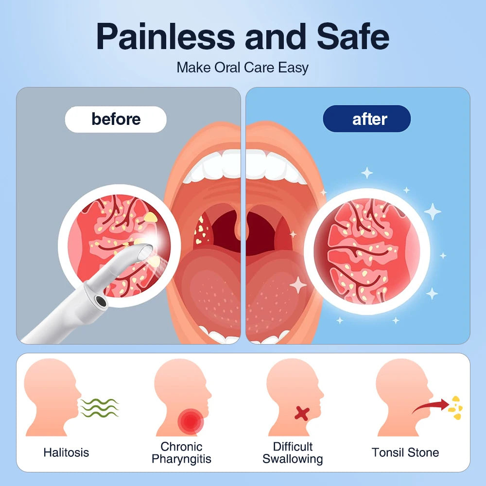 Tonsil Stone Remover Kit
