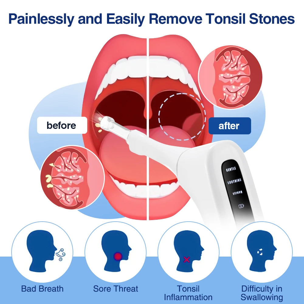 Tonsil Stone Remover Kit